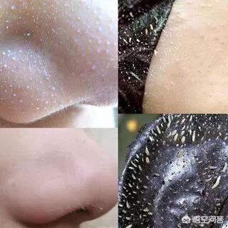 柏翠丝茶树去黑头套装真的有效吗（柏翠丝茶树去黑头套装使用方法）-第2张图片