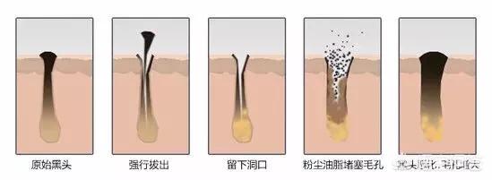 柏翠丝茶树去黑头套装真的有效吗（柏翠丝茶树去黑头套装使用方法）-第5张图片