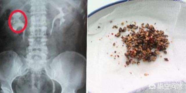 肾结石饮食方面要注意些什么（肾结石患者饮食禁忌需要注意什么）-第2张图片