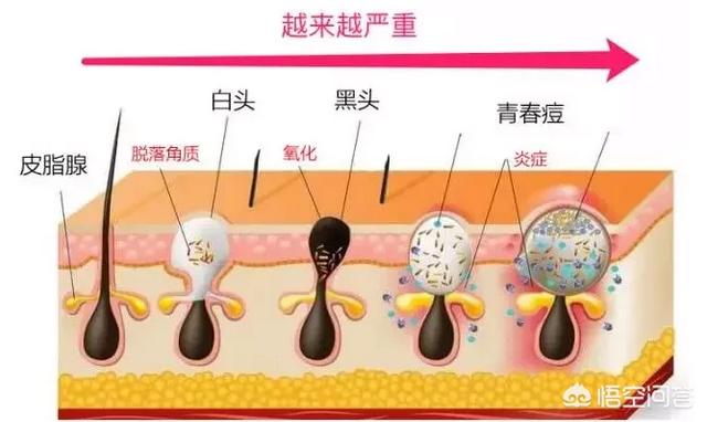 柏翠丝茶树去黑头套装真的有效吗（柏翠丝茶树去黑头套装使用方法）-第4张图片